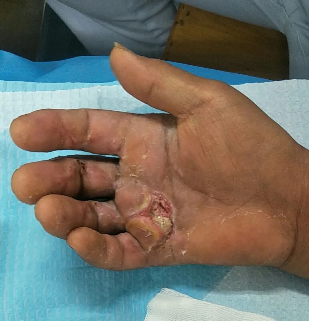 经过后期恢复,小莉的五个手指头都保住了!