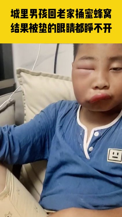 城里男孩回老家捅蜜蜂窝,结果被蛰的眼睛都睁不开