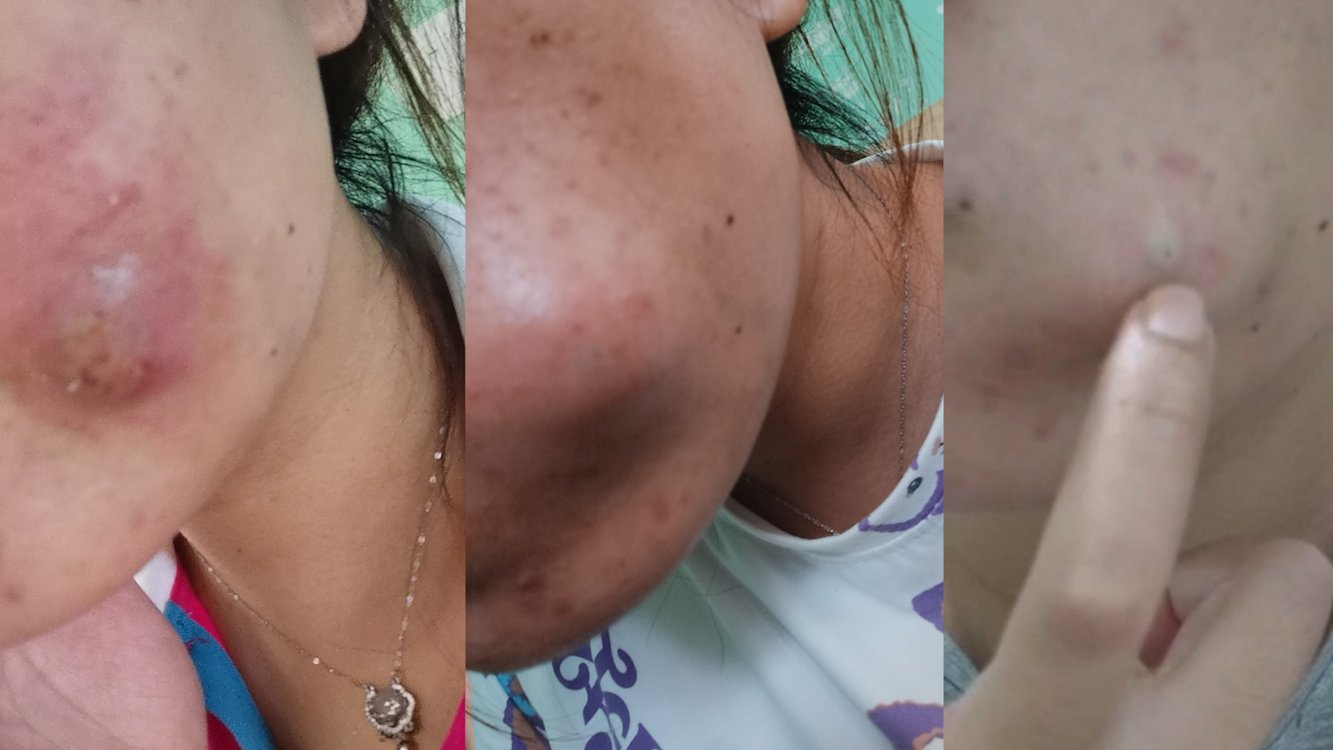 痘痘变囊肿福建女子挤痘感染发炎最后做手术缝合