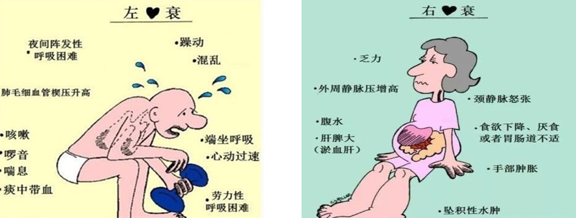 左心衰的表现多为肺淤血相关症状,右心衰竭的表现多为体循环淤血,其