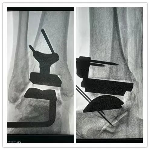 河南省首例国产人工踝关节置换术在信阳职业技术学院附属医院成功自主
