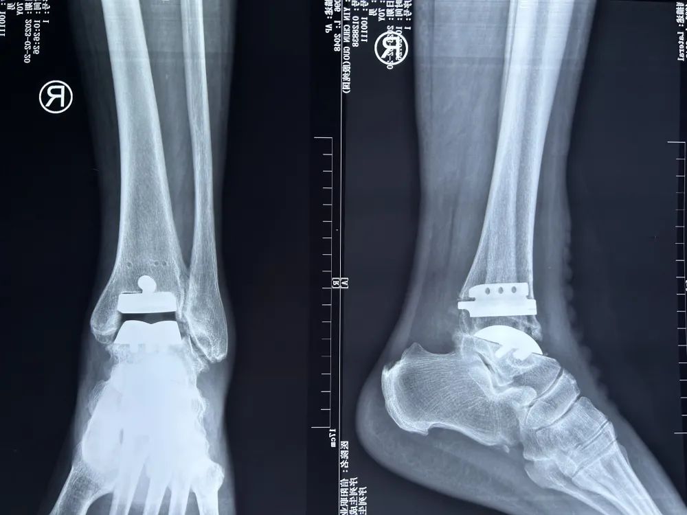 河南省首例国产人工踝关节置换术在信阳职业技术学院附属医院成功自主