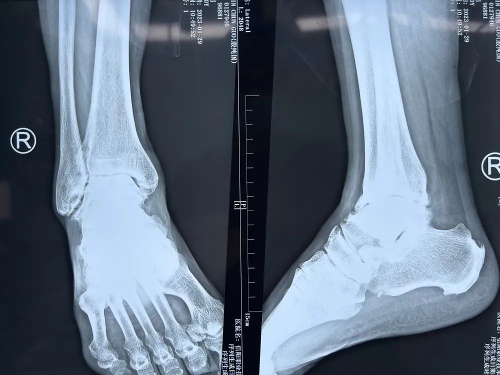 河南省首例国产人工踝关节置换术在信阳职业技术学院附属医院成功自主