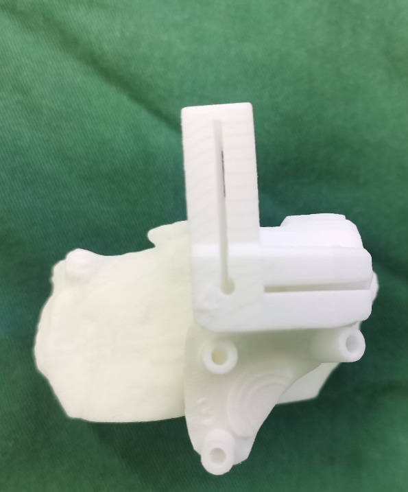 河南省首例ai3d打印截骨导板辅助下的膝关节单髁置换术顺利在郑州市