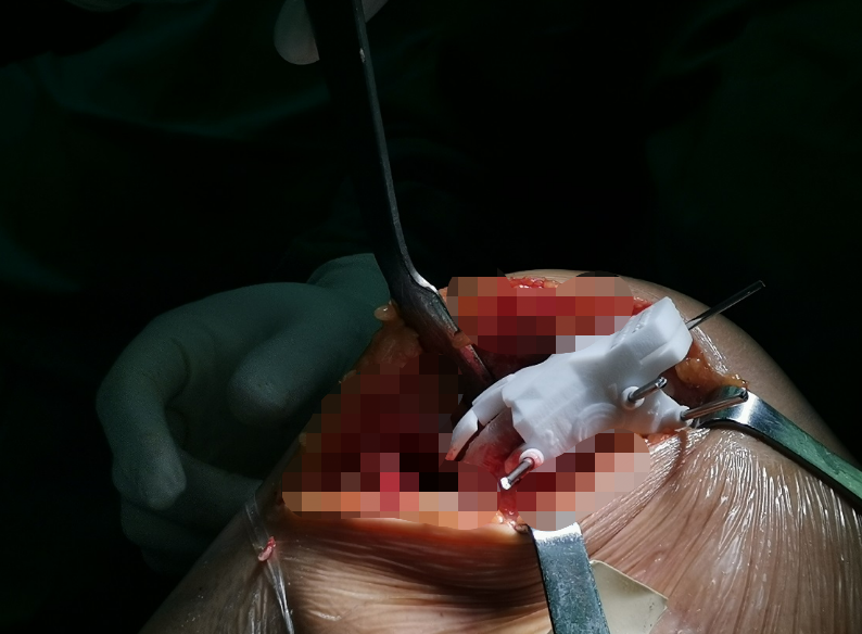 河南省首例！ai 3d打印截骨导板辅助下的膝关节单髁置换术顺利在郑州市骨科医院开展