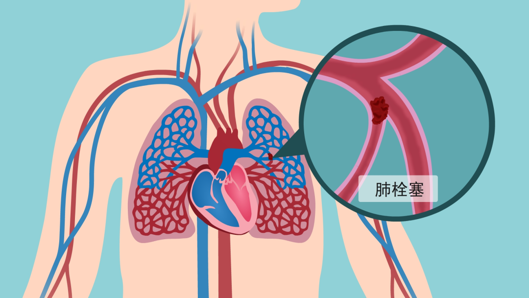 疗，但小韩的呼吸、循环改善不明显，必须尽快手术，采用介入置管溶栓。肺栓塞是指静脉里面血流瘀滞，形成了血块，脱落后随血流到心脏和肺动脉