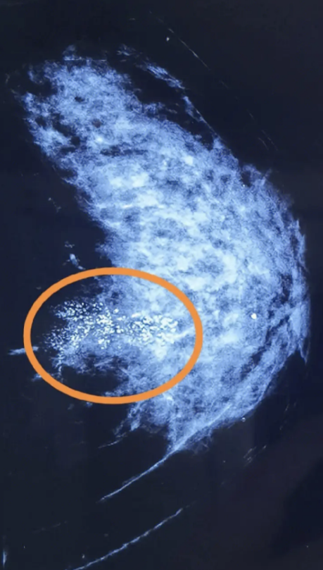 检查报告中的乳腺钙化可怕吗