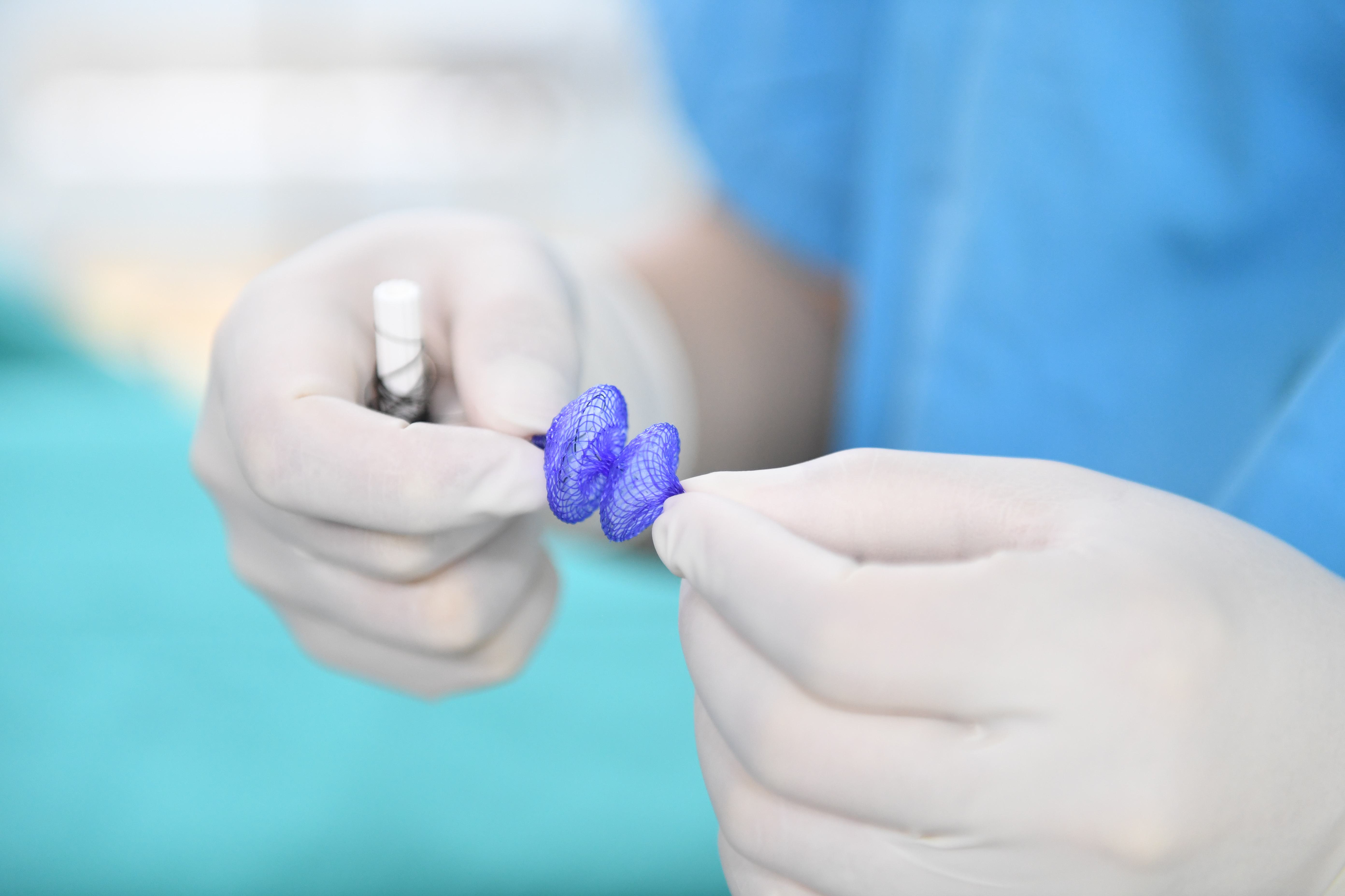 全国首例第二例可降解卵圆孔封堵器堵住心脏小眼