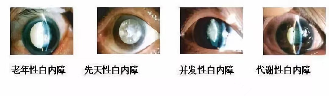得了白内障怎么办-大象网