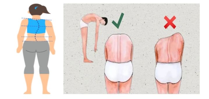 少年脊柱强中国脊梁壮脊柱侧弯