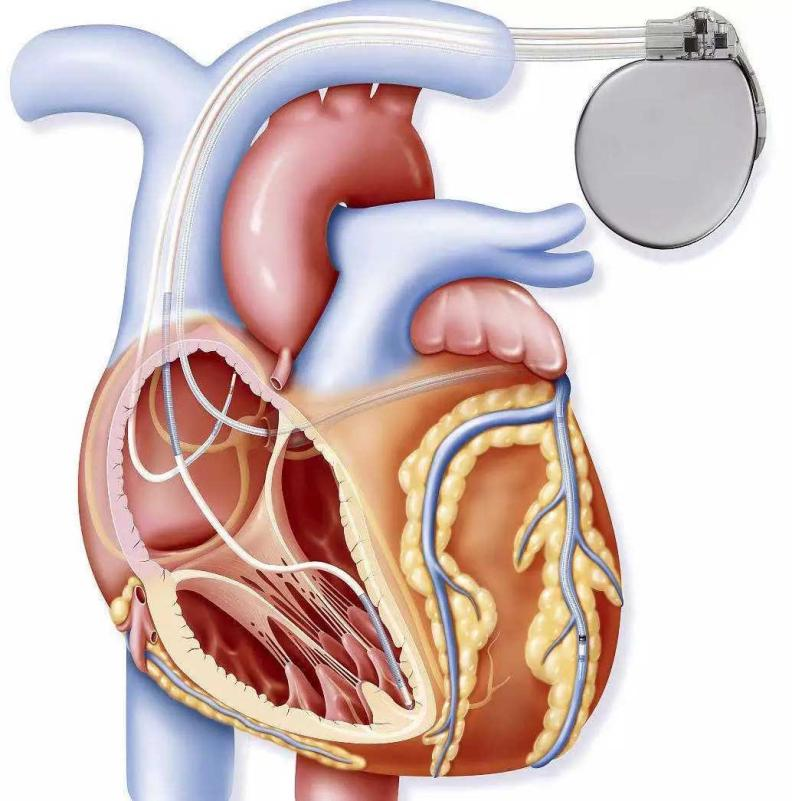 心衰患者植入心脏再同步起搏器后有哪些注意事项
