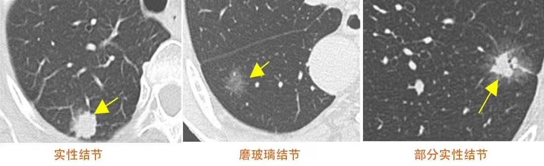 径≥10mm)。根据结节的密度可分为实性结节、磨玻璃结节、部分实性结节。