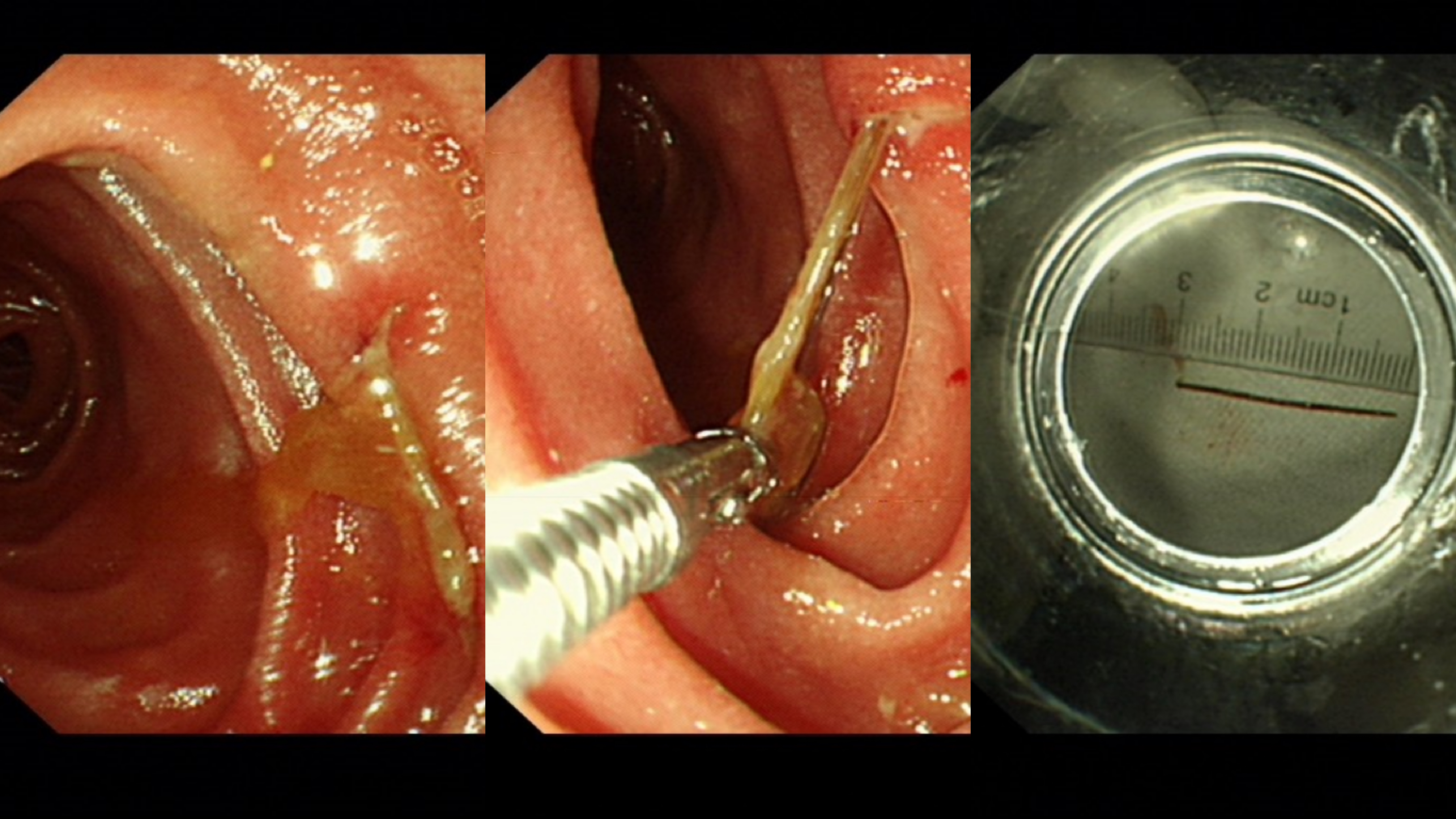 检查中发现患者十二指肠降部有一个3cm异物,考虑鱼刺,且已经刺入肠壁