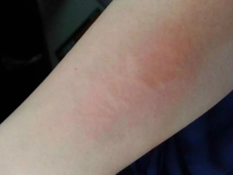 ②鼻子过敏:花粉过敏引起的季节性变应性鼻炎,也称"花粉症",会出现鼻