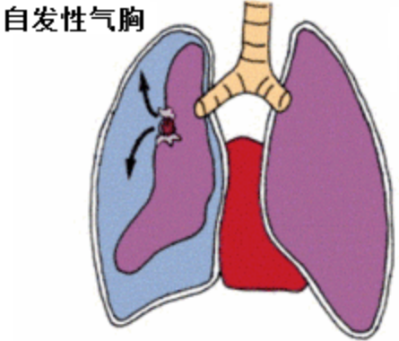 李现彪:"气胸"别生气,"大疱"事不大
