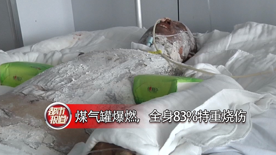 直播:煤气罐爆燃,全身83%特重烧伤,还未脱离危险期!