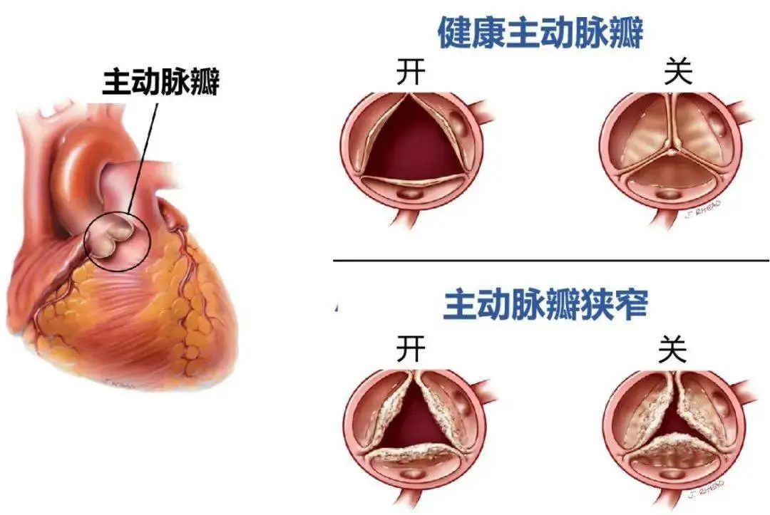心脏瓣膜图示图片