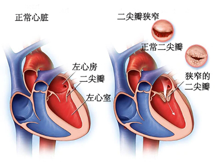 崔文鹏:守护心门—心脏瓣膜病解读