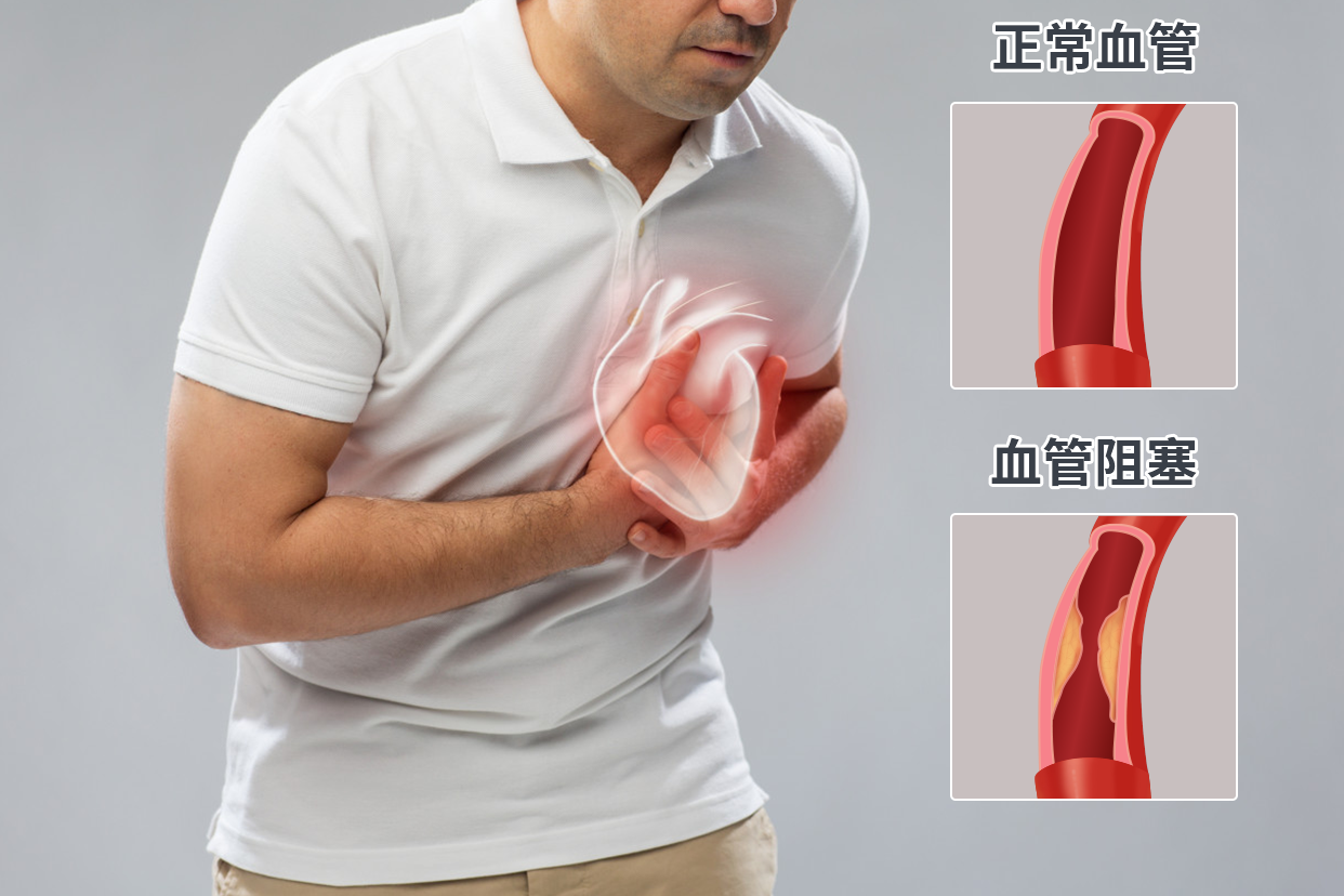 揭秘血管堵塞的真相与防治