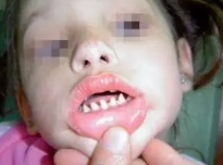 哪吒同款鲨鱼牙可能患有罕见病 引发大众关注