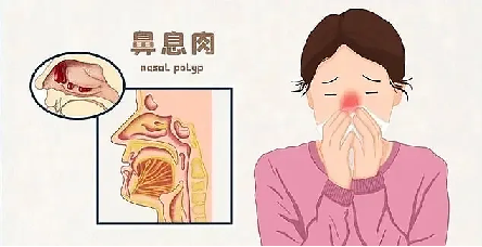 郑州民生耳鼻喉医院：50岁大叔闻不到饭菜香？当心，可能是鼻息肉在作怪！