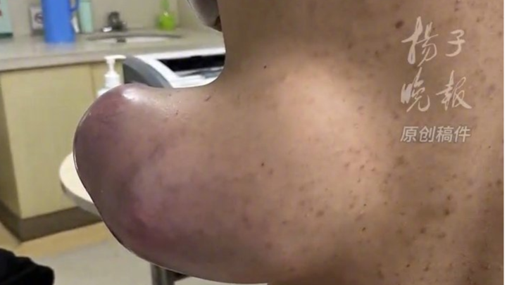 男子背上肿物疯长如树桩 重达3斤