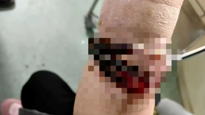 女子手镯10年没摘竟“长”进肉里！医生：再晚点就保不住了