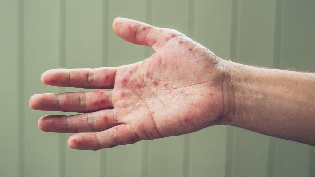 手足口病仍处高位流行态势，家长注意这些误区！