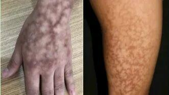 一觉睡醒长出“蟒蛇纹”、水疱！冬季警惕这类烫伤