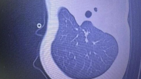 早上开始发烧，晚上就“白肺”了！医生提醒