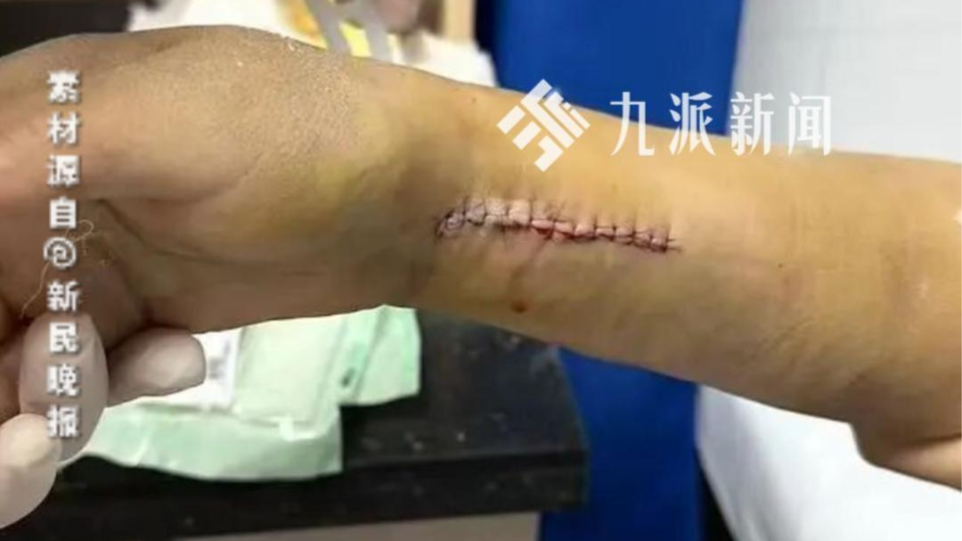 上海一6旬女子踩天桥铝条滑倒缝26针