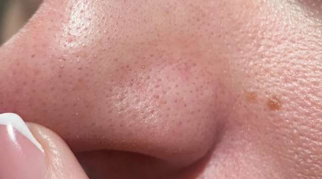挤出黑头后，让毛孔迅速缩小的办法，很多人还不知道！
