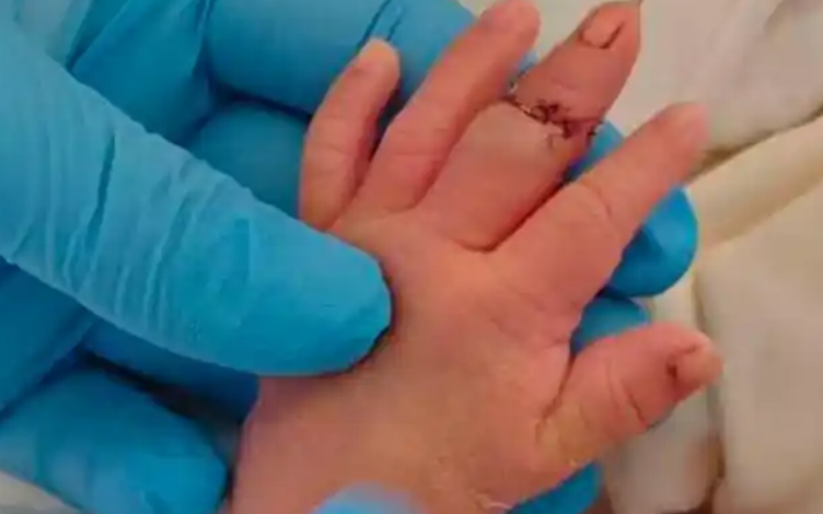 新生儿剪脐带时疑被助产士剪断手指 家属已申请医疗事故鉴定