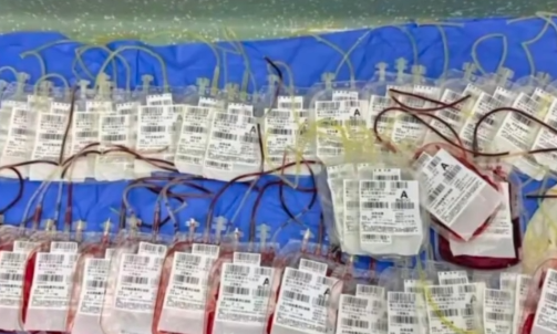 女子长发卷入机器头皮从眼眶至后颈全撕脱，输血万余毫升救命