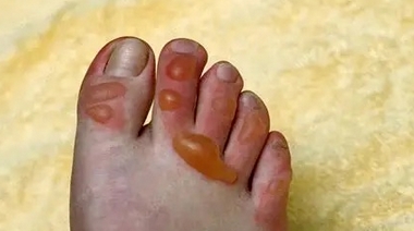 突然炸了！烫出满脚泡！不少人家里也有