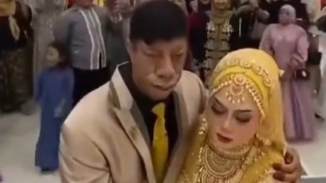 印尼河马脸男子迎娶貌美新娘，五兄妹中四人因患病面容畸形