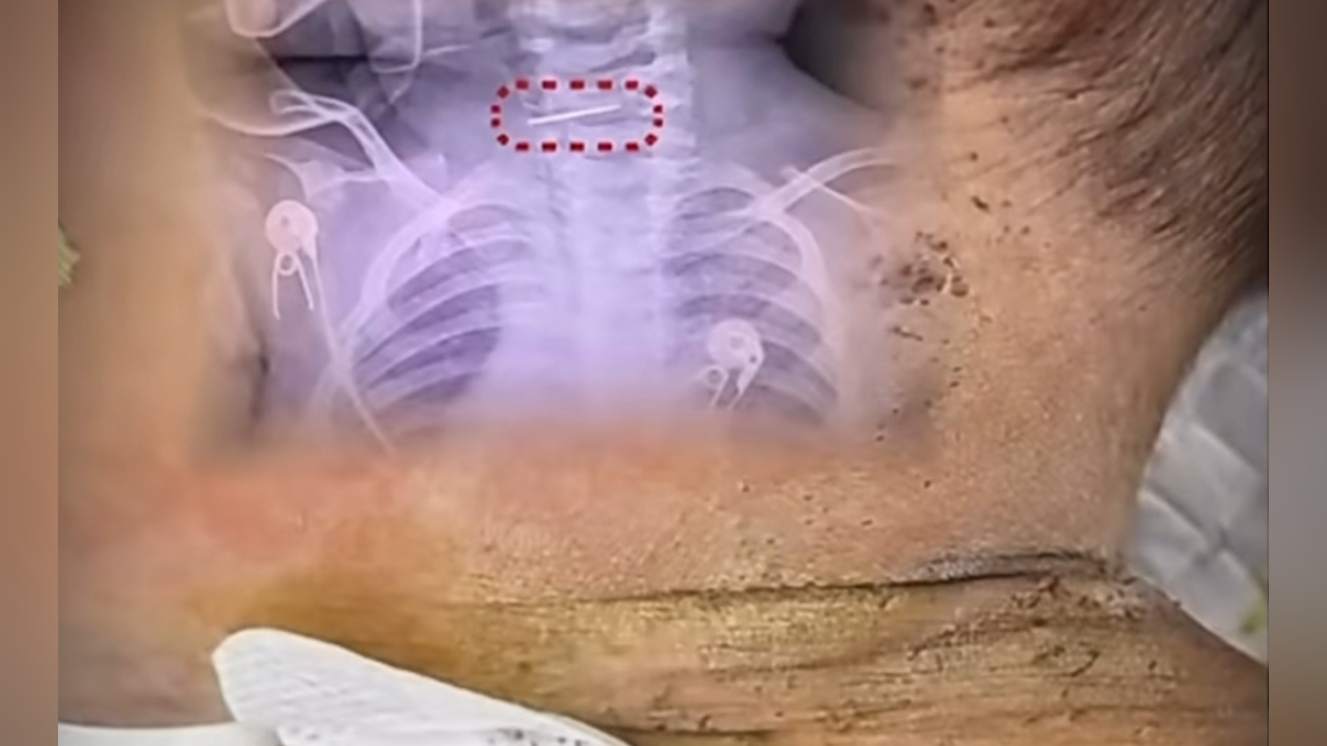 10个月男婴被母亲扎数百针 官方最新回应：马上发调查报告