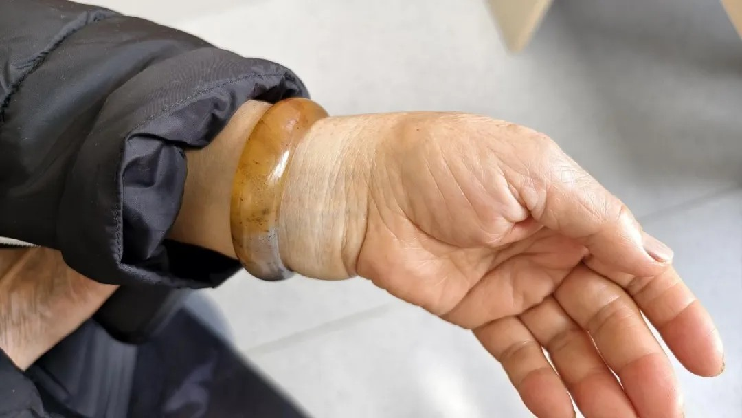 手腕摔伤肿胀镯子越卡越紧……“大白”和“蓝朋友”联手攻坚