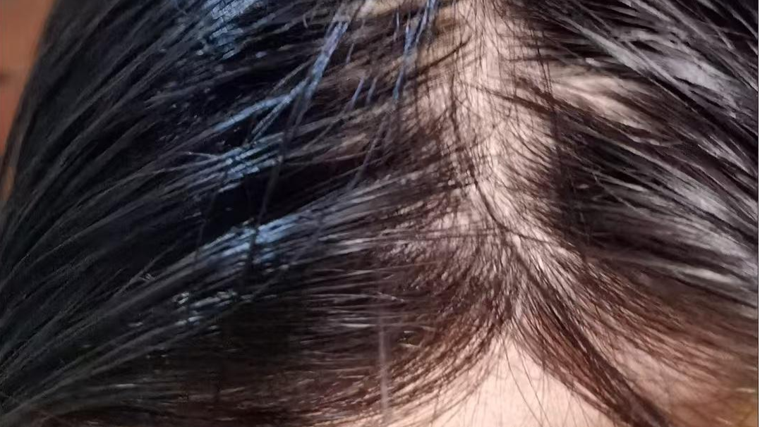 产后脱发，会再长回来吗？