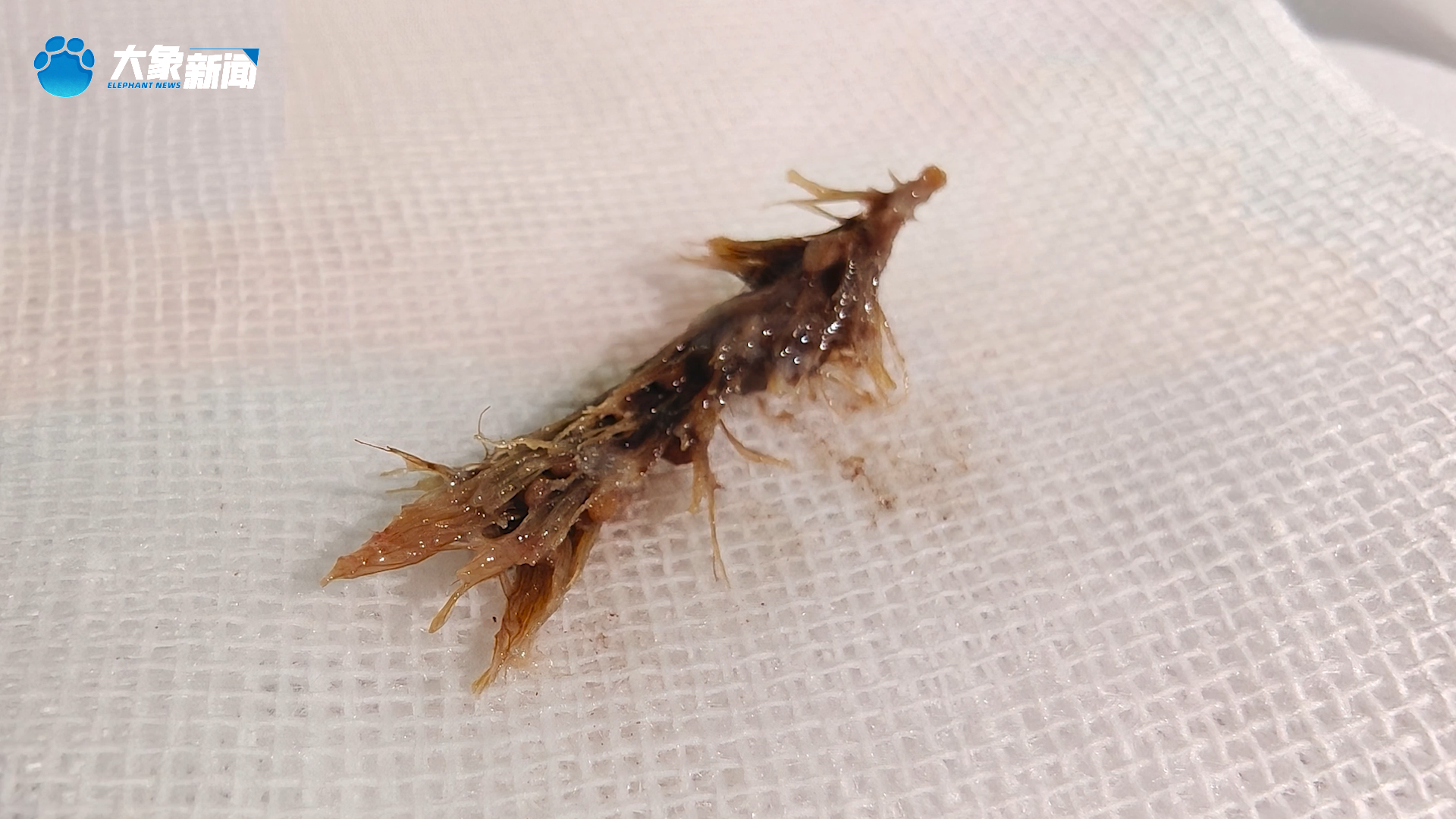 8岁男童突发咳血 竟因肺中藏半年狗尾巴草