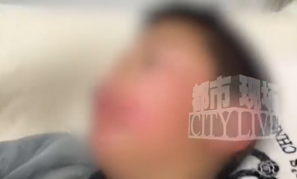 10岁男孩舔嘴唇舔出羊胡子疮