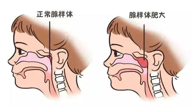 郑州民生耳鼻喉医院详解——耳朵不舒服，为啥要查鼻子？