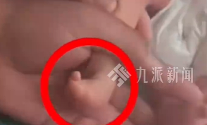 试管婴儿出生右脚缺4趾产检未发现，当地卫健委已介入调查