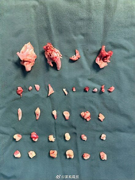 18岁女生腹中肿块里还有24颗牙齿
