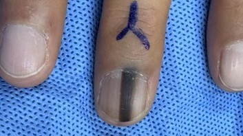 指甲上突然长出黑线是癌症信号吗？专家教你如何识别与应对