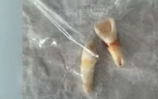 男孩看望离异母亲遭其同居男友打掉2颗牙，母亲包庇父亲报警