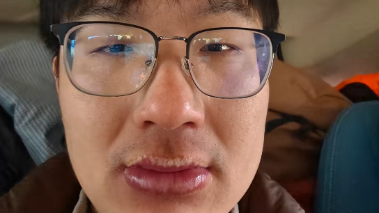 男子贡嘎徒步被晒伤嘴唇肿成香肠