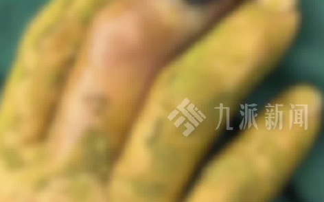 硬核自救！53岁阿姨被2米眼镜蛇咬伤徒手活捉