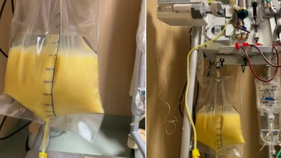 女子炫完小龙虾又吃冰西瓜被送进ICU：血液已成了“乳白色”