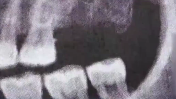 男子拔牙3小时挂水13天，口腔鼻腔拔通，拆线漏2根，涉事医院：拔通很常见